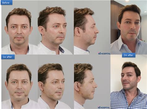 Men S Plastic Surgery Types Of Surgeries For Men Idhospital