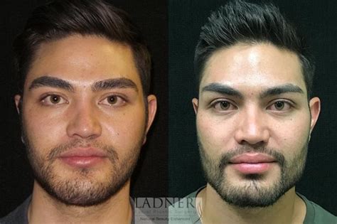 Masculine Plastic Surgery for Men's Health