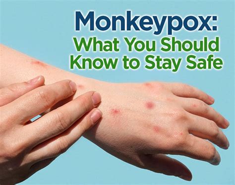 Monkeypox Stay Informed Stay Safe Lee Health