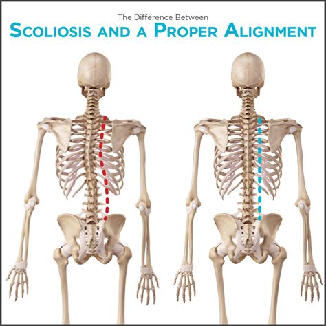 Normal Spine Vs Scoliosis