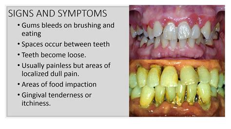 Optimization Of Conservative Treatment Of Chronic Granulating Periodontitis In Combination With Chronic Tonsillitis