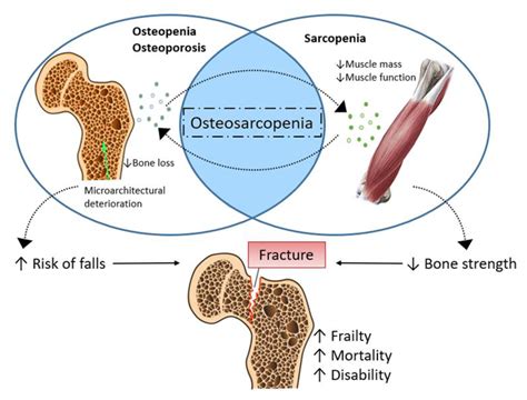 Osteoporosis Review Article 2023