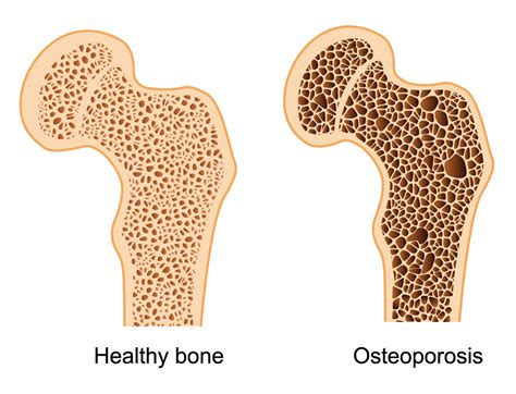 Osteoporosis Who