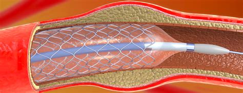 Pci Medical