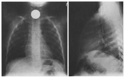 Radiopaque Foreign Bodies Examples