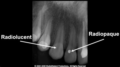 Radiopaque Meaning