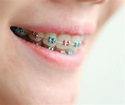 Saving Money On Braces