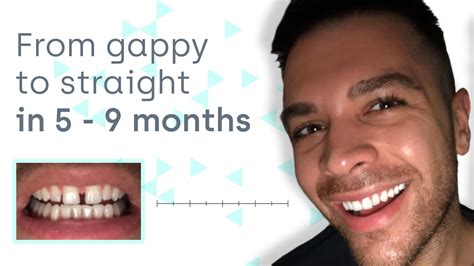 Say Goodbye To Teeth Gaps No Braces Needed