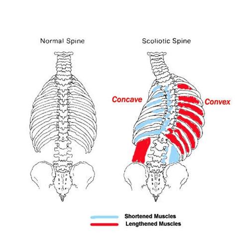 Scoliosis Named For Convexity