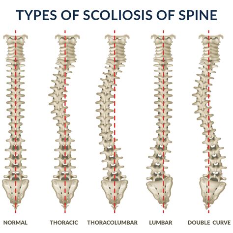 Scoliosis Symptoms Causes Treatment And More