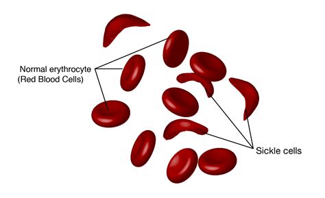 Sickle Cell Anemia