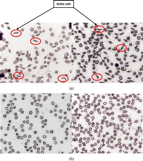 Sickle Cell Dataset