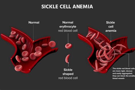 5 Ways Sickle Cell Impacts Public Health