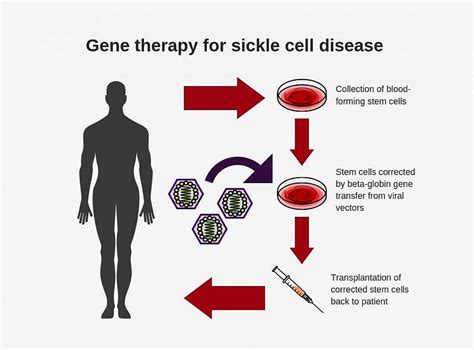 Sickle Cell Gene Therapy