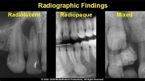 Simple Healthcare Definition Of Radiopaque