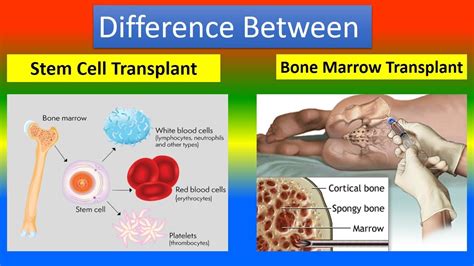 Stem Cell Transplant Bone Marrow Transplant