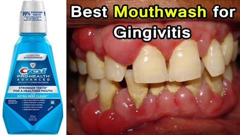 Strong Mouthwash For Gum Disease