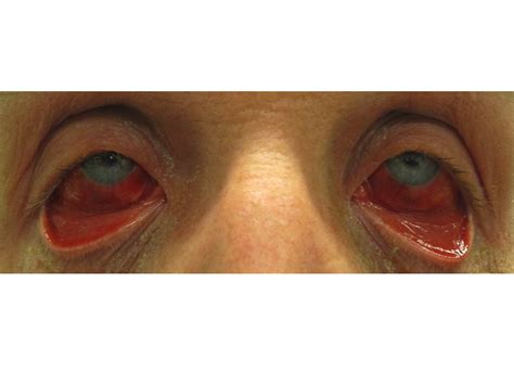 Terapi Cespleng Untuk Ahc Konjungtivitis Dramatis Acute Hemorrhagic Conjunctivitis Ahc Ini Salah Satu Infeksi Akibat Virus Yang Klinisnya Paling Dramatis Dok Penyebabnya Paling Banyak Karena Virus Cukup Diberikan Artificial Tears Aja Kalau