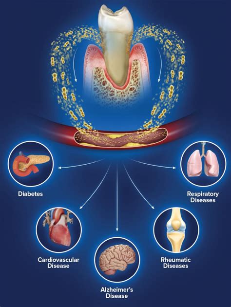 The Mouth Body Connection Periodontist In Birmingham Al Gum Disease Treatment