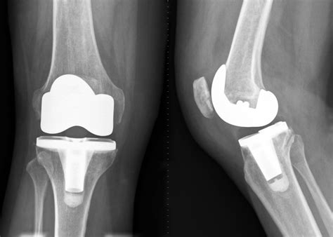 Total Knee Replacement