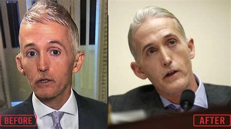 Trey Gowdy Nose Surgery