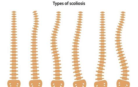 Types Of Scoliosis Appearance Of Scoliosis Dextroconvex Curvature