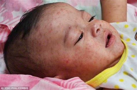 Unvaccinated Child May Have Exposed Texas Students To Measles Daily Mail Online