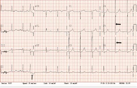 Ventricular Contractions Military Disqualification