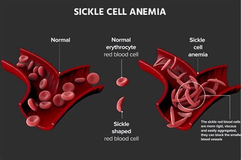 What Is Sickle Cell Disease Sickle Cell Anemia World Sickle Cell Day Kauvery Hospital