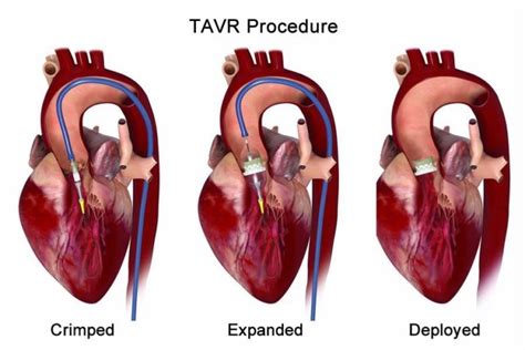 What Is Tavr Procedure