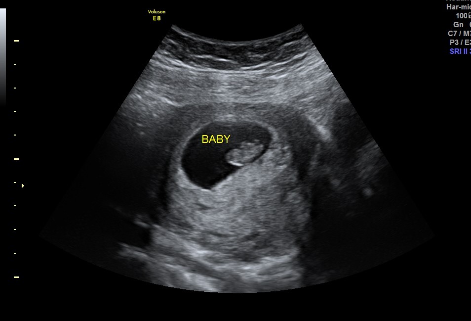 Who Does Ultrasounds For Pregnancy