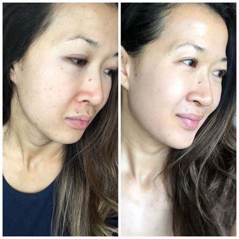 Zo Skincare Before And After